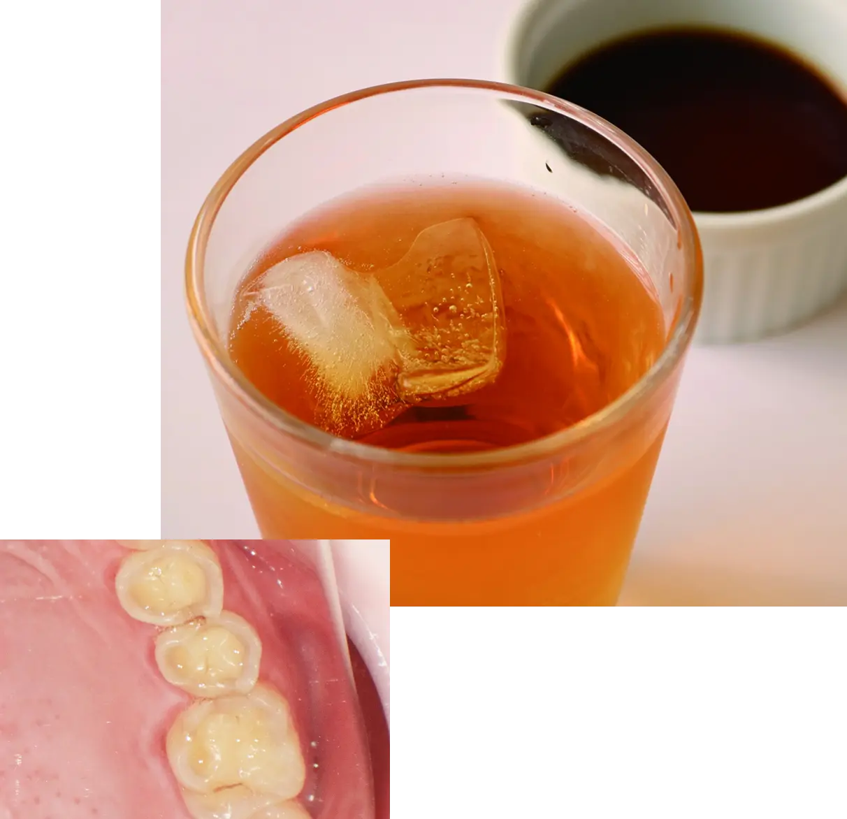 酸によって歯が溶ける病気
              「酸蝕症」