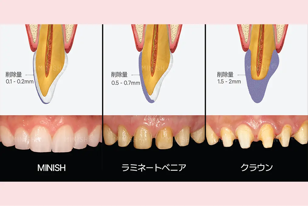 歯や歯ぐきへの刺激を抑え、痛みを感じにくい